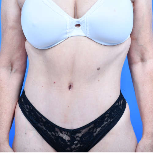 Tummy tuck front after