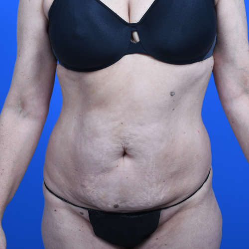 Tummy tuck front before