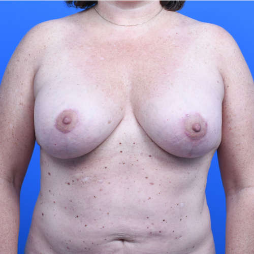 Breast lift with implants front after