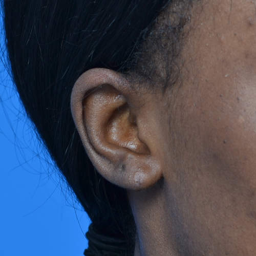 Earlobe right oblique after