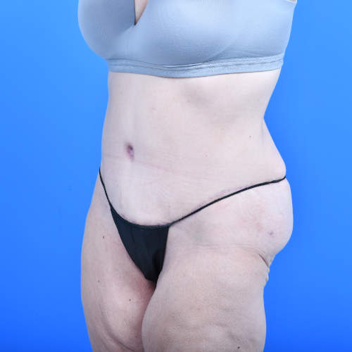 Tummy tuck lo after 3 months