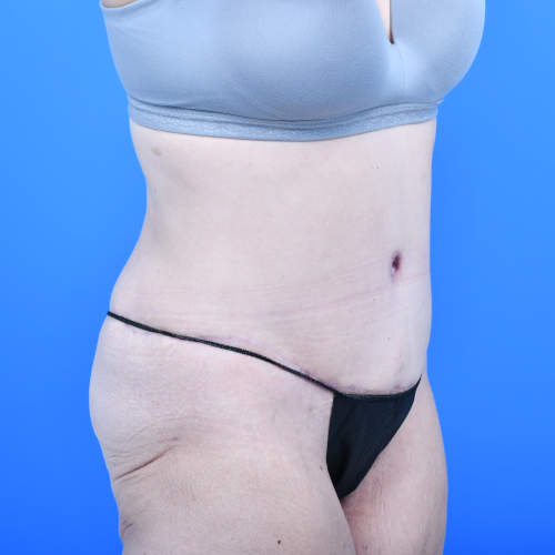 Tummy tuck ro after 3 months