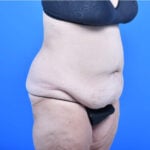 Tummy tuck ro before 3 months
