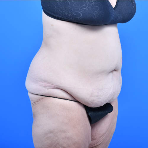 Tummy tuck ro before 3 months