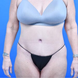 Tummy tuck front after 3 months