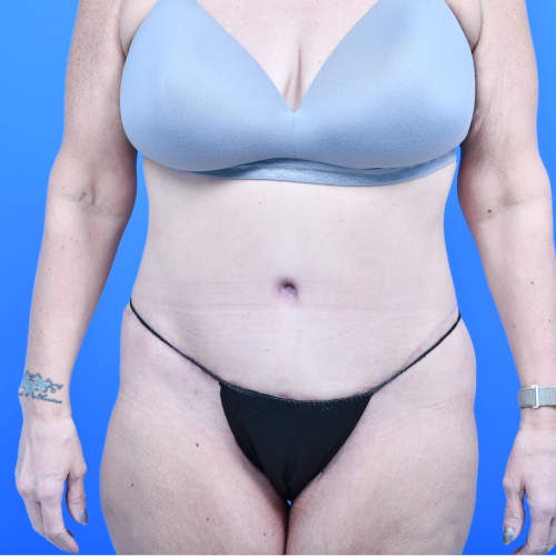 Tummy tuck front after 3 months