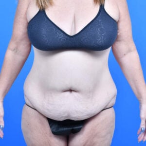 Tummy tuck front before 3 months