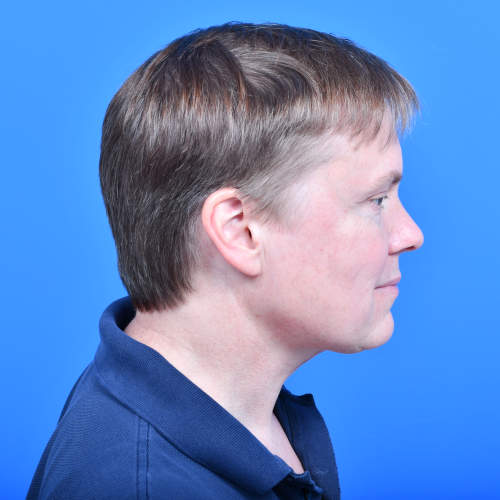 Male neck tzplasty rside after