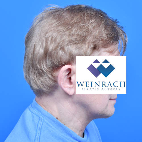 Male neck lift tzplasty after rside