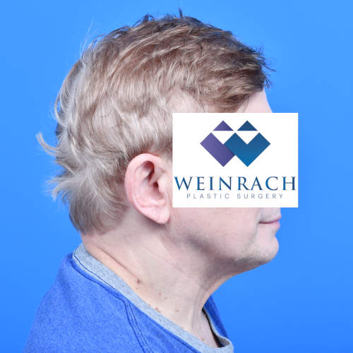 Male neck lift tzplasty before rside