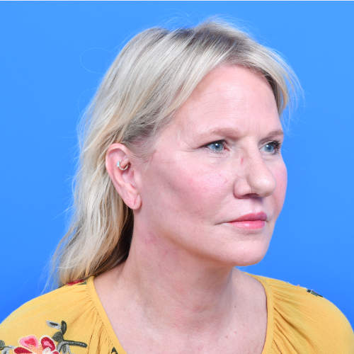 Facelift liplift eyelids ro after