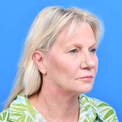 Facelift liplift eyelids ro before