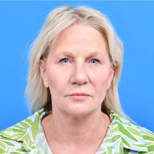 Facelift liplift eyelids front before