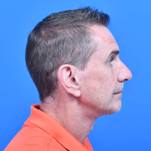 Otoplasty after right side