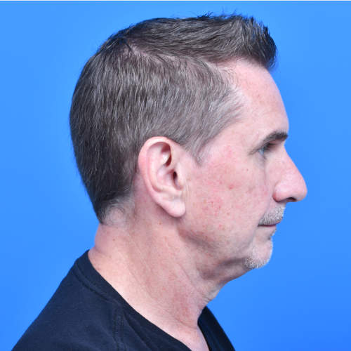 Otoplasty before right side