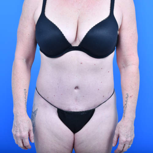 Tummy 5months front after