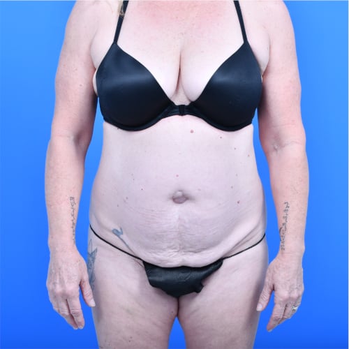 Tummy tuck safelipo before front