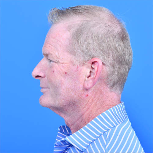 Tzplasty after left side