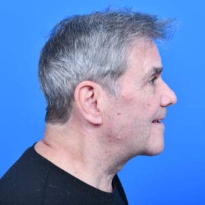 Tzplasty direct neck lift after rside