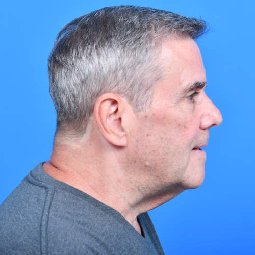 Tzplasty direct neck lift before rside