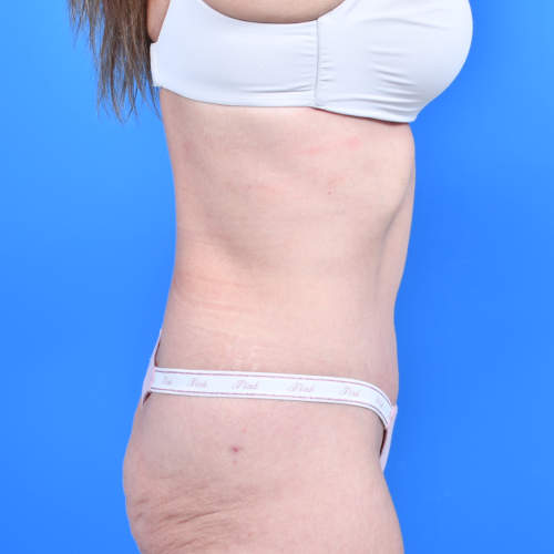 Tummy tuck right side after