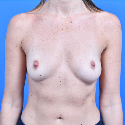 Breast augmentation motiva 275 ergonomix front before