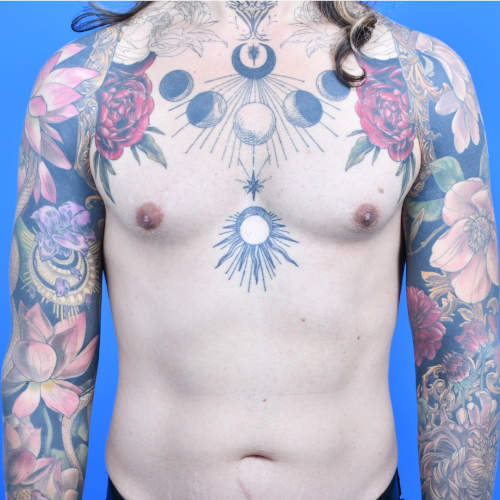 Gynecomastia excision after front