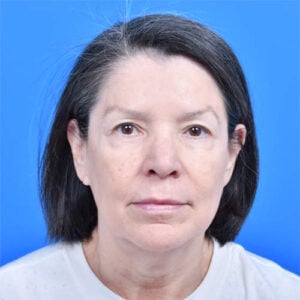 Upper eyelid lift front before