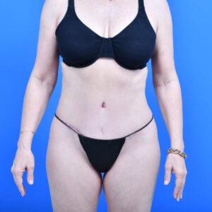 Tummy tuck safelipo flanks and back in scottsdale; front view after