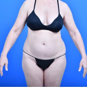 Tummy tuck safelipo flanks and back in scottsdale; front view before